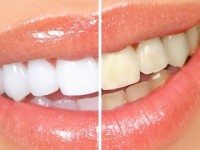 Ого, какой эффект! Отбеливать зубы в домашних условиях — легко! Народные способы, как избавиться от желтизны эмали.