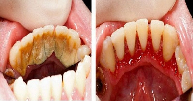 Узнай, как легко удалить зубной камень и сделать улыбку белоснежной! Даже не надеялась на такой эффект…