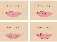 Омоложение кожи вокруг губ: что нового в косметологии?