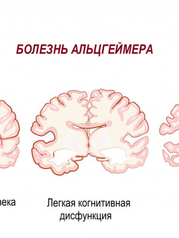 Его отец страдает от болезни Альцгеймера. То, что делает для мужчины сын, удивило весь мир!