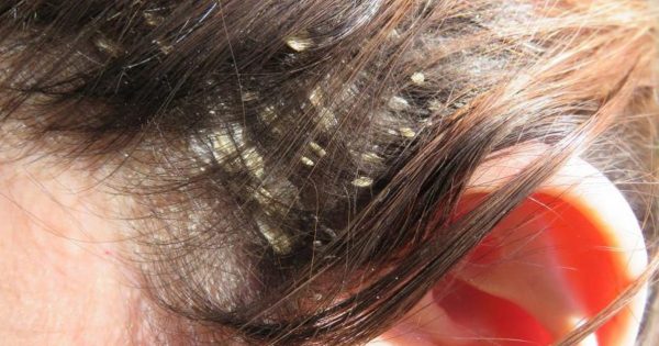 Как быстро избавиться от перхоти: 8 натуральных средств, которые вернут волосам прежнюю красоту!