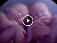 Близняшки подрались в утробе матери! Смотрите удивительное видео!