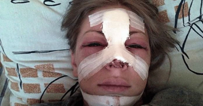 Российская певица отсудила 2,2 миллиона у изуродовавшего ее пластического хирурга