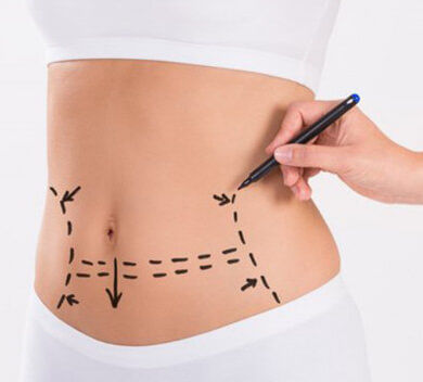 липосакция